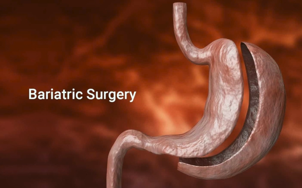 Bariatric Surgeries